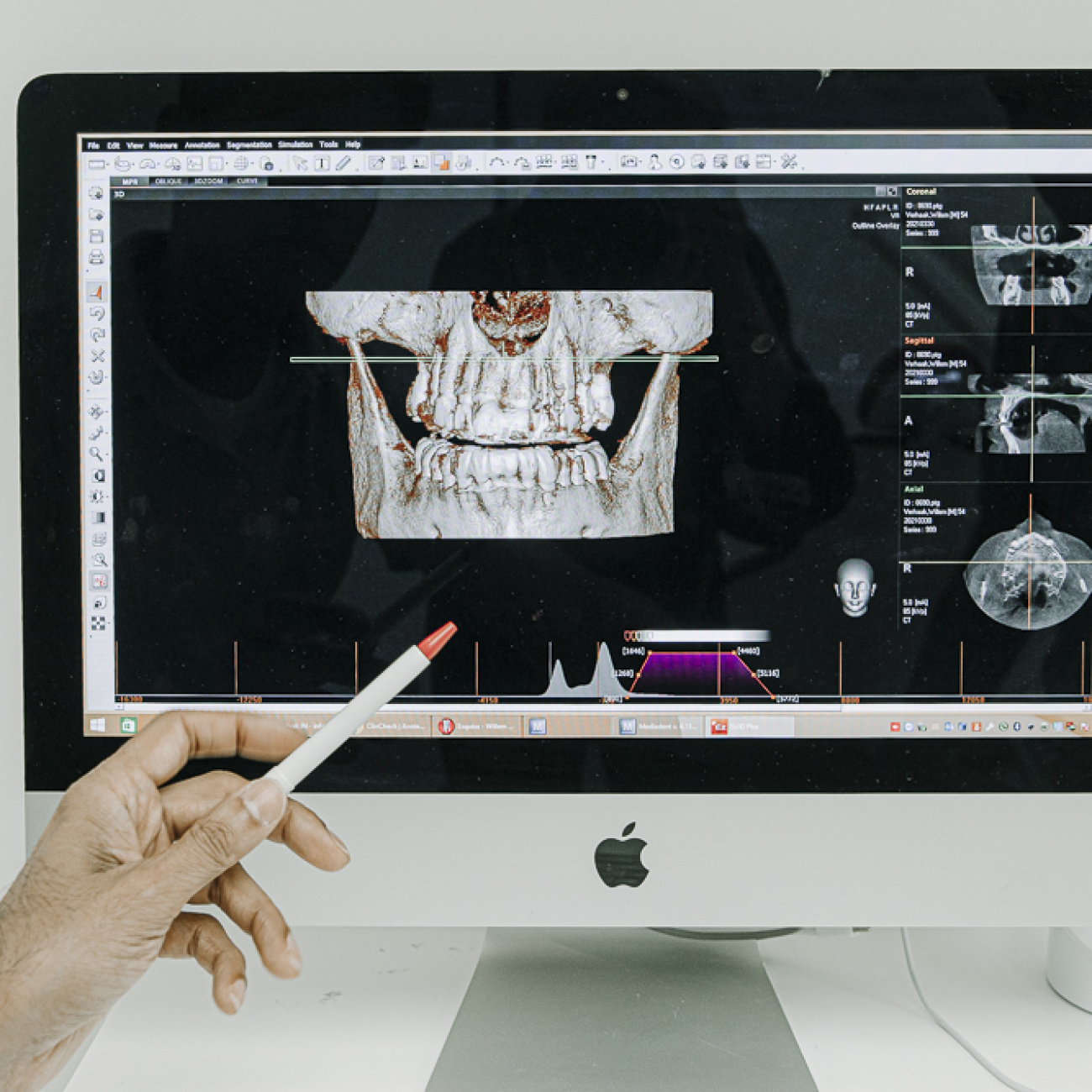 Implantaat aanbrengen | THCC
